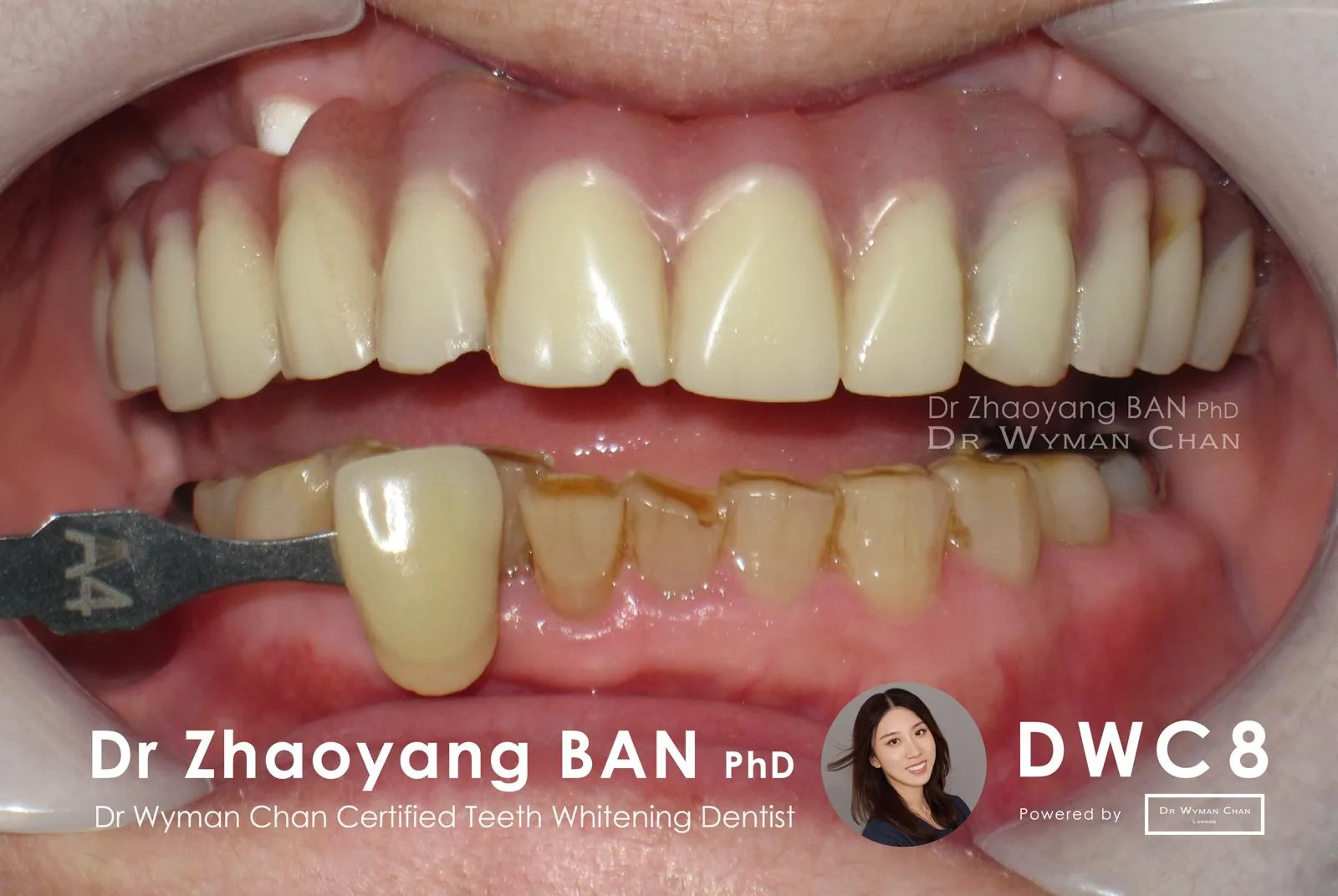 DWC8 case, before treatment: A4 VITA shade baseline on a sensitivity-prone patient.