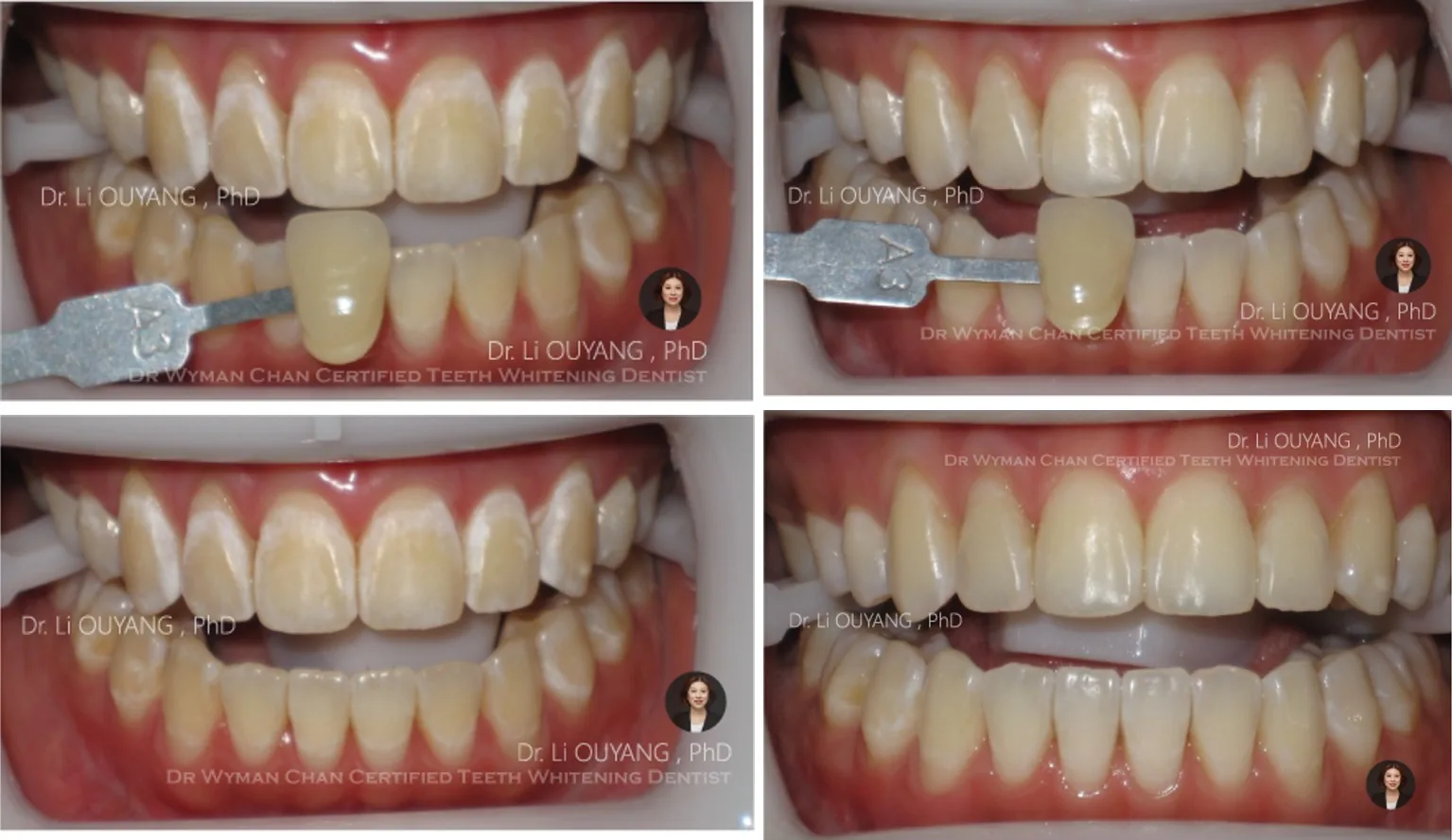 DWC8 case showing patchy white-spot demineralisation before treatment, and visibly even, remineralised enamel after a two-week DWC8 course.