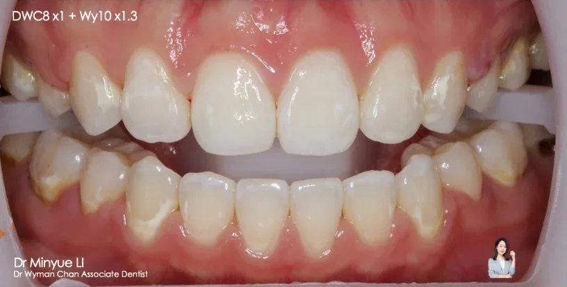 DWC8 + Get2Smile case, after: visibly even, brighter smile after the combined protocol.