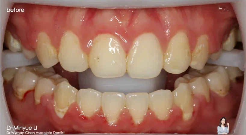 DWC8 + Get2Smile case, before: patchy and stained enamel.