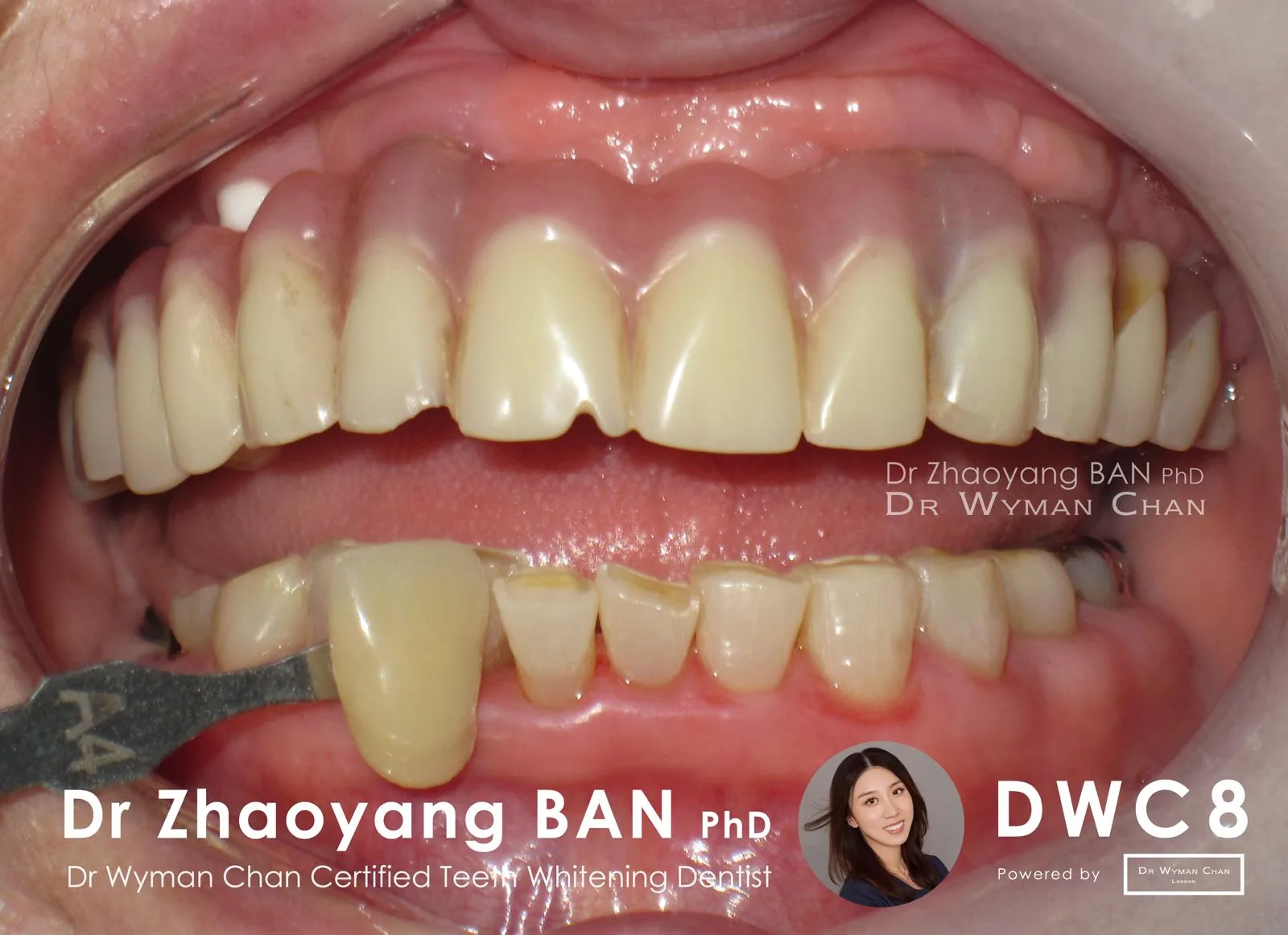 DWC8 case, after: visibly lighter shade with the patient comfortable throughout the course.