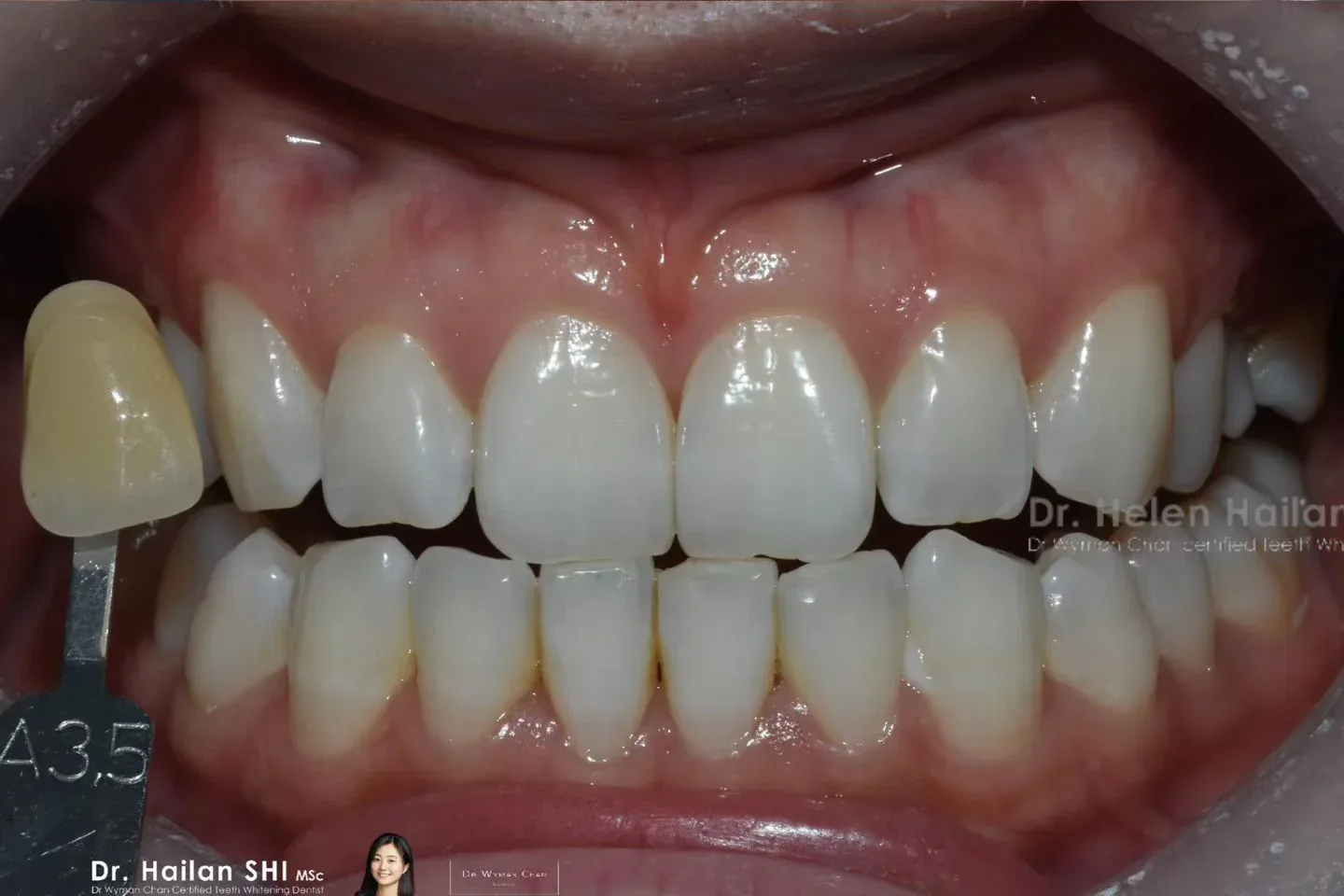 DWC8 case, after: visible shade change from baseline across a DWC8 course, no marginal sensitivity.