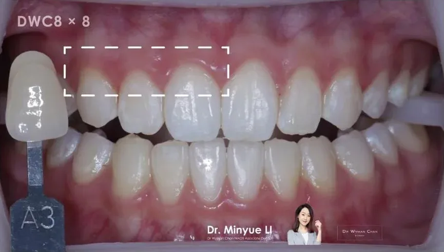 DWC8 case, after: measurable shade change without the marginal sensitivity that usually drops patients off.
