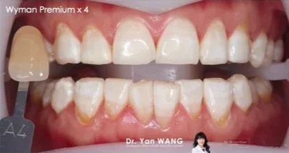 Get2Smile case, after: visibly lighter and more even shade after a four-week course of Get2Smile with Classic HP6.