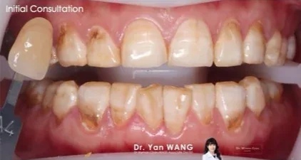 Get2Smile case, before: heavily stained baseline.