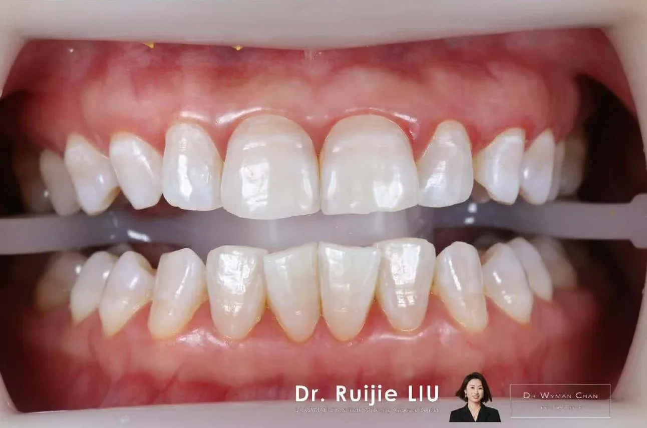 Get2Smile case, after a four-week course of Get2Smile with Classic HP6: visibly lighter shade.