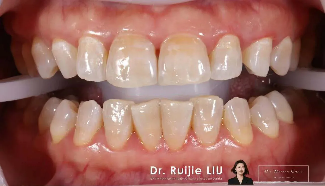 Get2Smile case, before treatment: baseline shade.