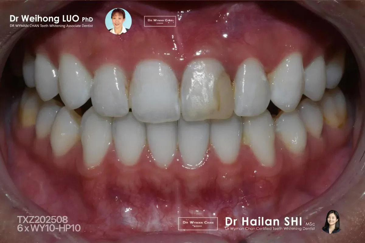 Get2Smile case, after: same patient post-course visibly lighter.