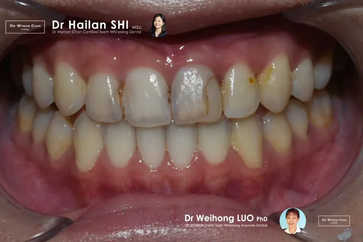 Get2Smile case, before: shaded baseline with shade tab reference.