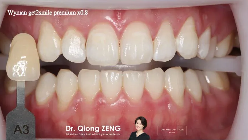 Get2Smile case, after: visible shade change after two weeks of Get2Smile Classic HP6 paint-on whitening.