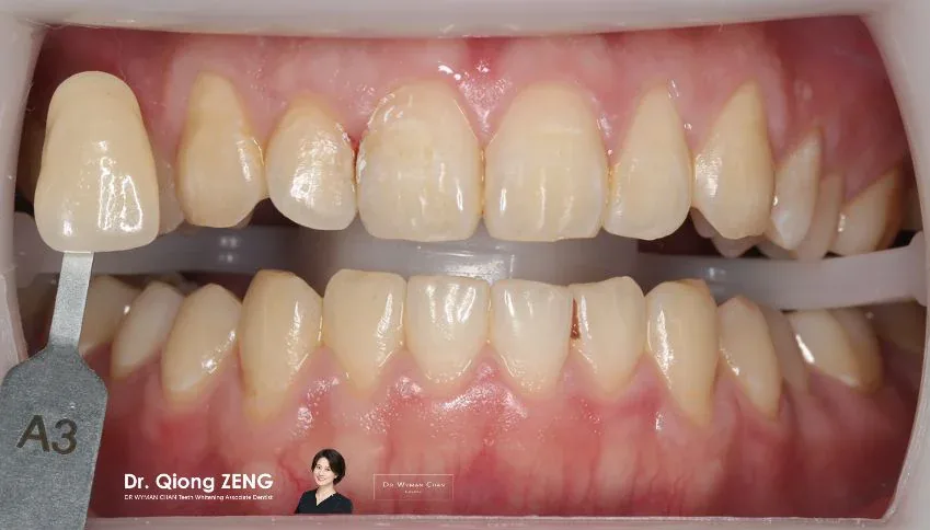 Get2Smile case, before: baseline shade.