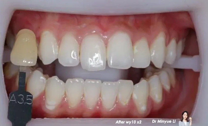 Get2Smile case, after: visibly lighter and more even after a three-week course of Get2Smile Classic HP6.