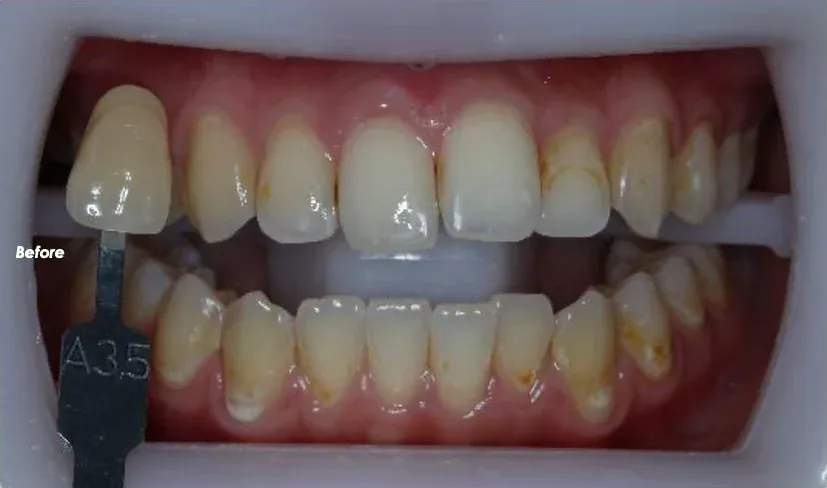 Get2Smile case, before: baseline shade.