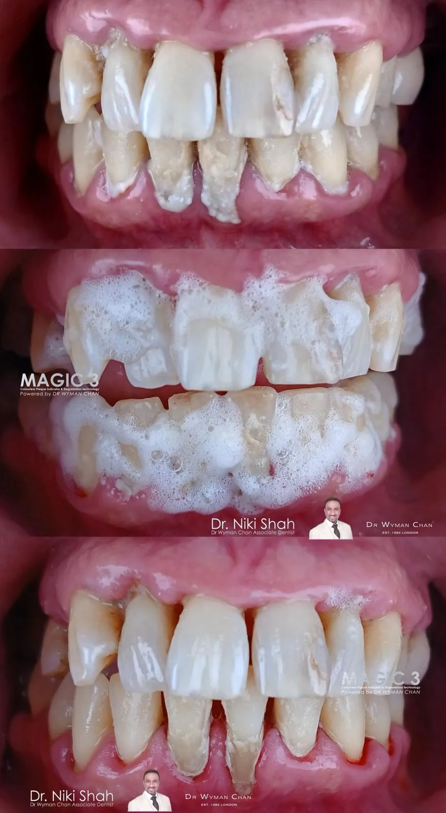 Magic 3 three-stage case: heavy biofilm and inflamed gums before, the colourless foam mid-application disclosing and degrading plaque, and the same mouth after a single rinse with calmer gingival tissues.