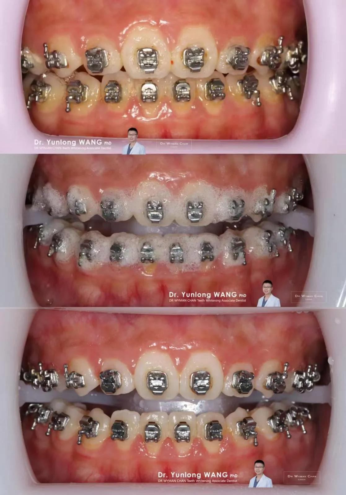 Magic 3 case: yellowed enamel before treatment, the colourless foam mid-application protecting the enamel, and visibly cleaner teeth after a single rinse.