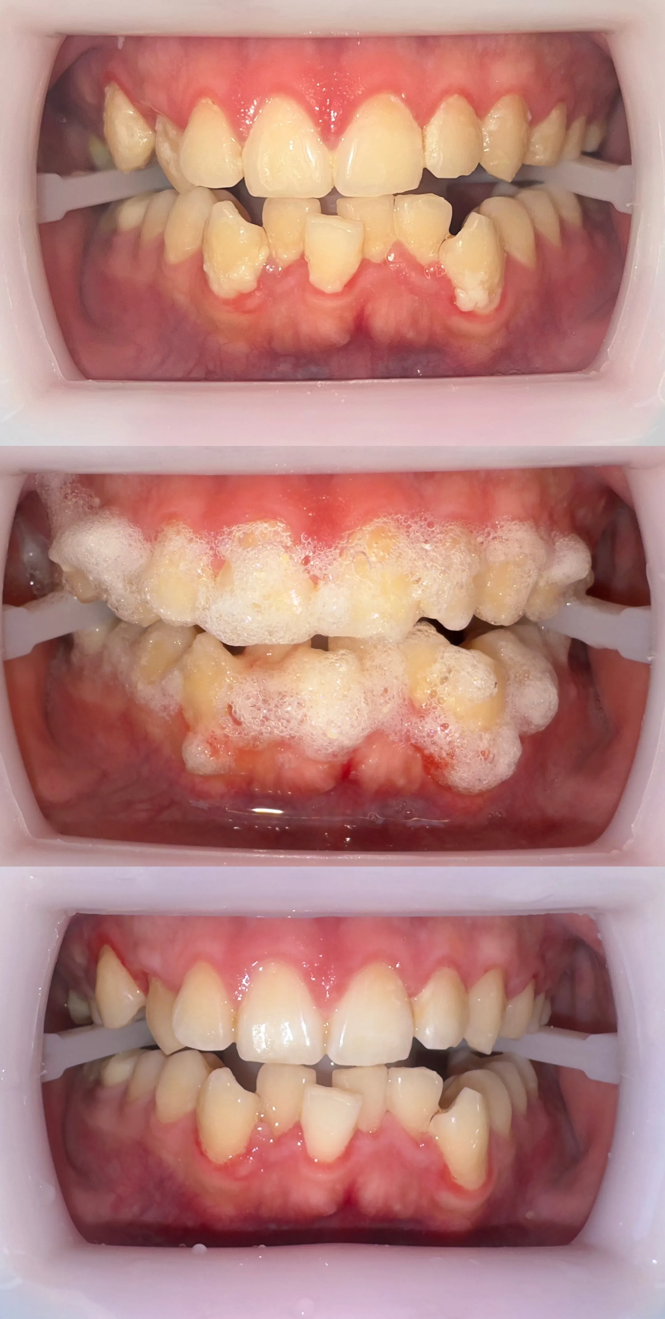 Magic 3 case showing the standard hygiene protocol: heavy plaque before, the foam degrading biofilm during, clean enamel after &mdash; no scaler, no aerosols.