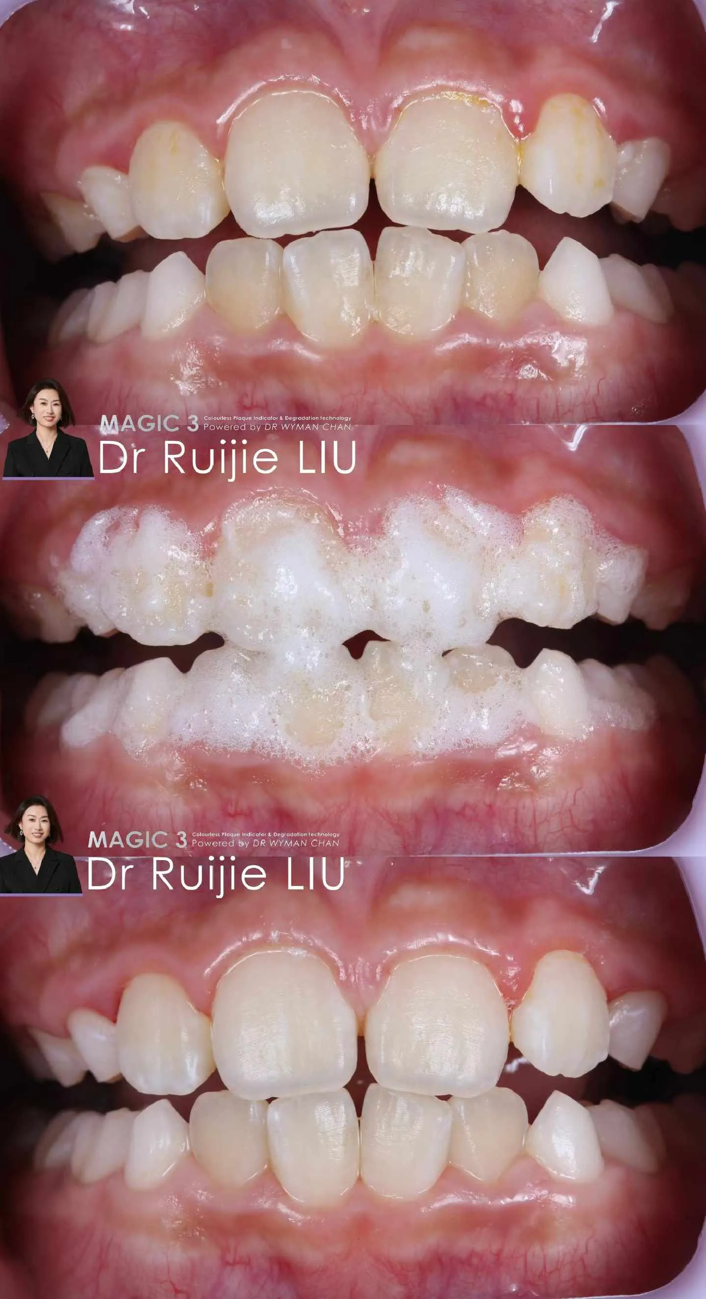 Magic 3 case: inflamed gingival margins and visible plaque before, foam in action mid-protocol, and gum tissues calmed after the 10-minute application.