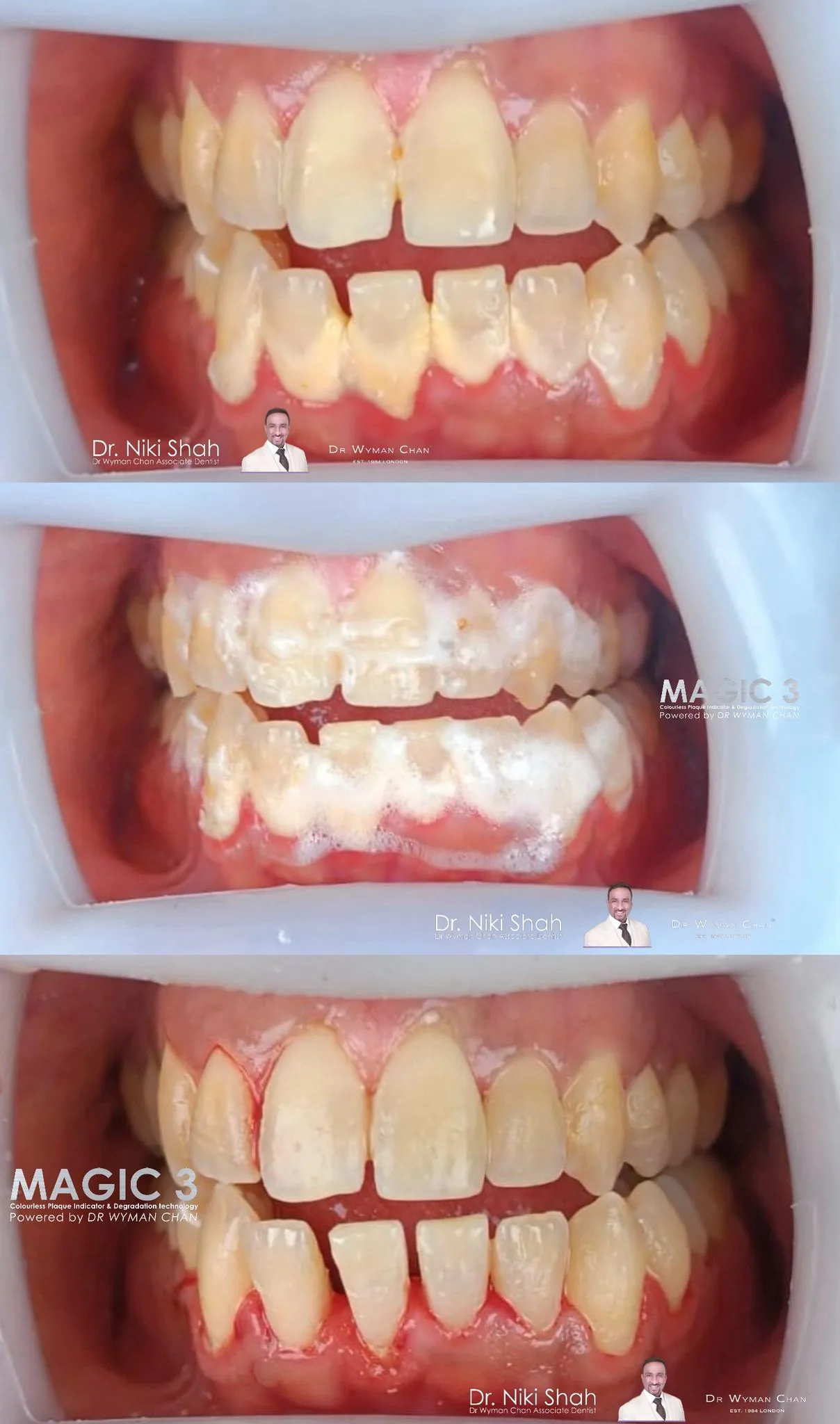 Magic 3 case demonstrating the foam mid-application: thick white foam covers the teeth as the colourless plaque indicator disrupts the biofilm.