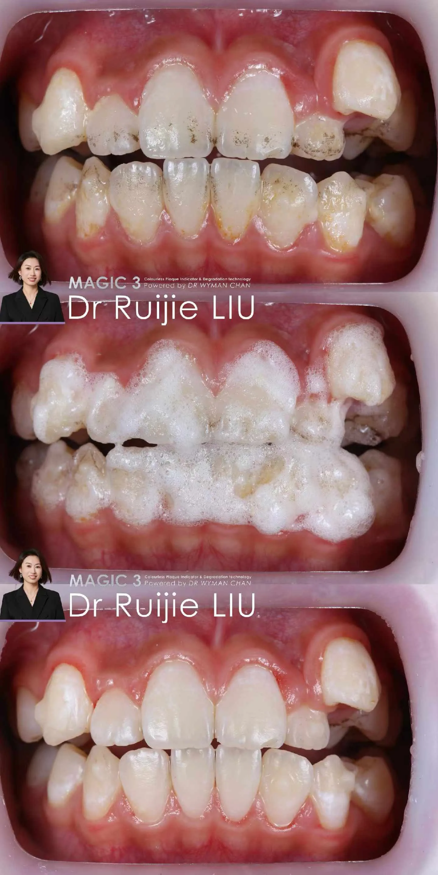 Magic 3 case: significant plaque accumulation and gingival inflammation before, foam mid-application, and a notably calmer, cleaner result after a single rinse.