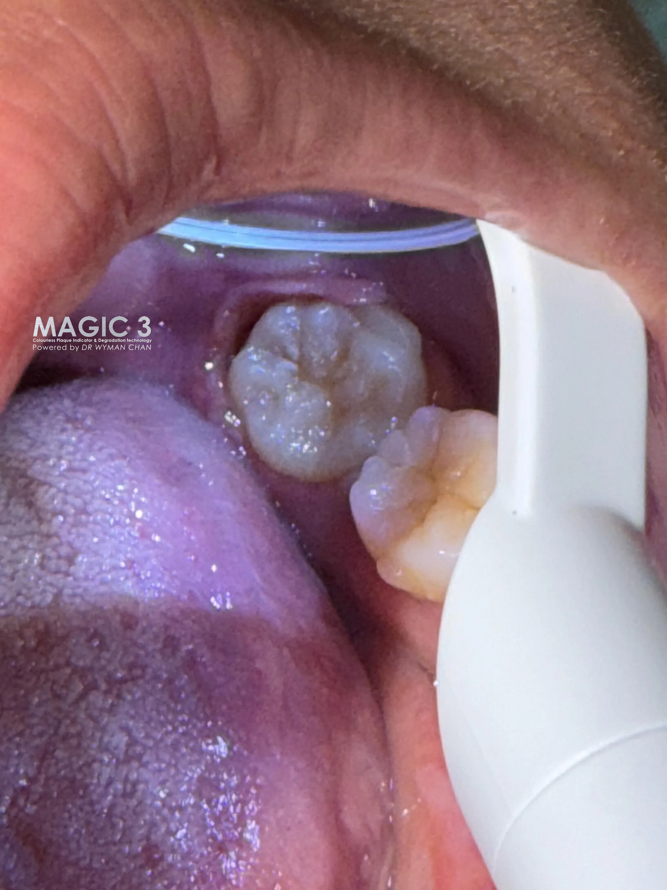 Same area after a single Magic 3 application: operculum cleared, surrounding gingival tissue calmer, no instrumentation used.
