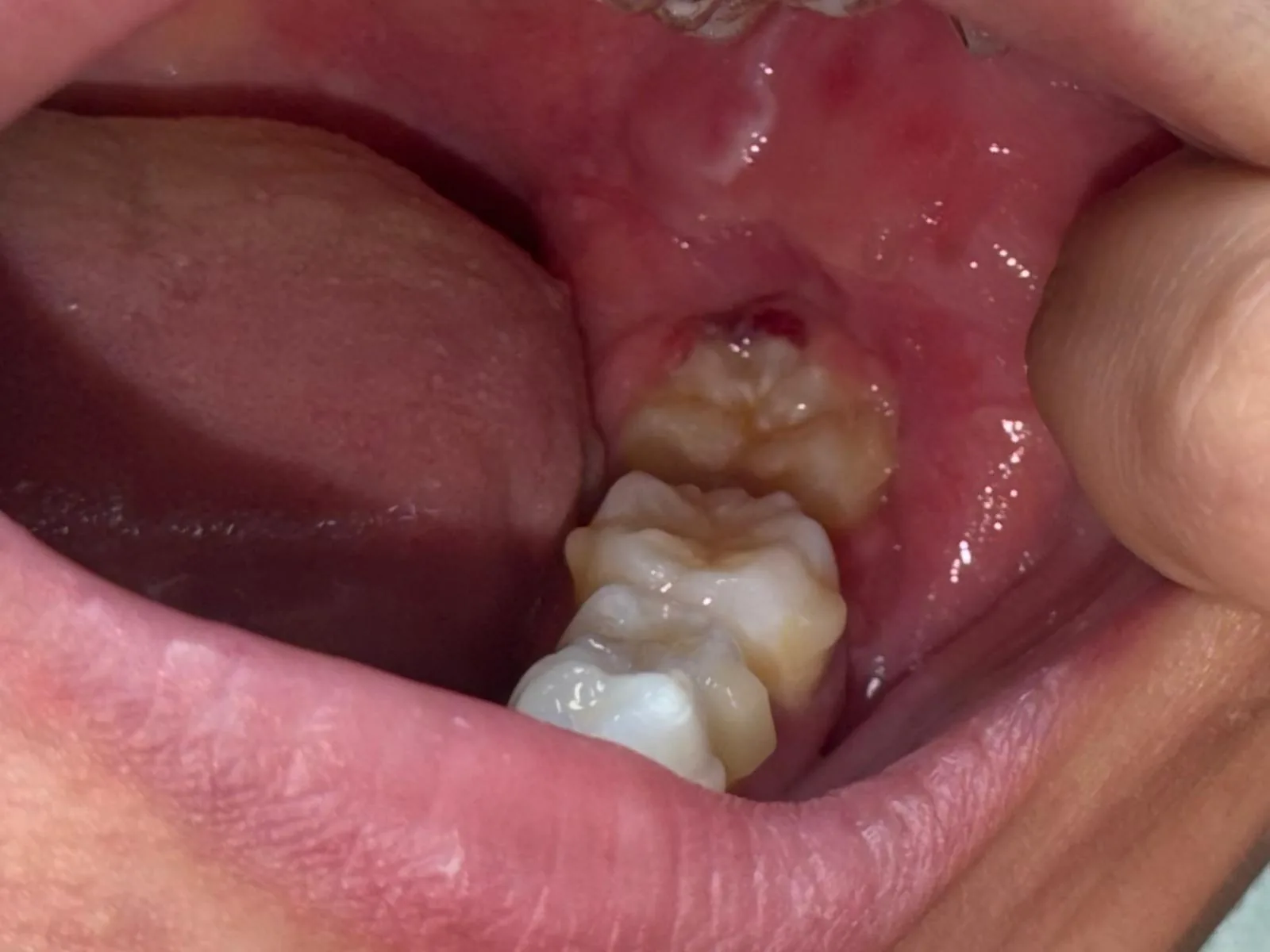 Lower right wisdom tooth before Magic 3: operculum inflamed, food trap visible, surrounding gingival tissue red and swollen.