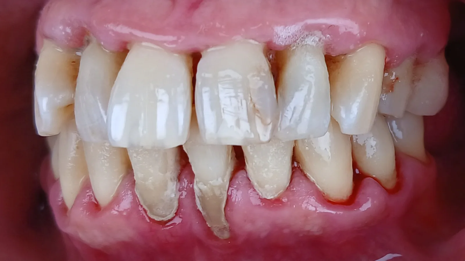 Premier Magic 3 case, after a single 10-minute application: clean enamel, calmer gingival margins, no instrumentation.