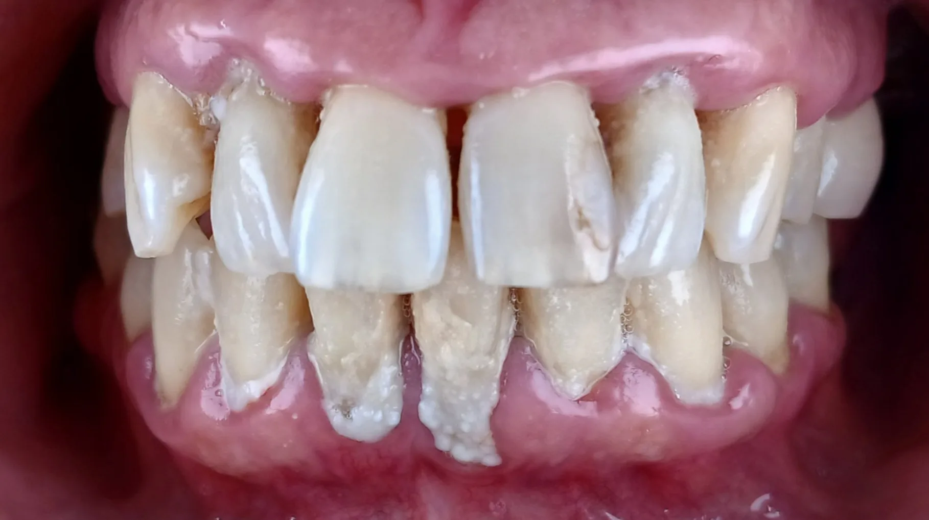 Premier Magic 3 case, before treatment: heavy biofilm and gingival inflammation visible across both arches.