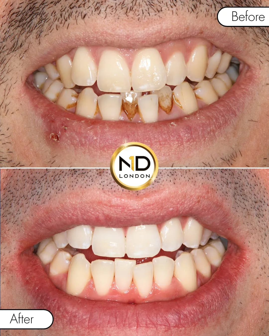 HP6 + Perfect Trays case: before-and-after composite showing visibly lighter shade after a course of HP6 worn one hour daily in custom Perfect Trays.