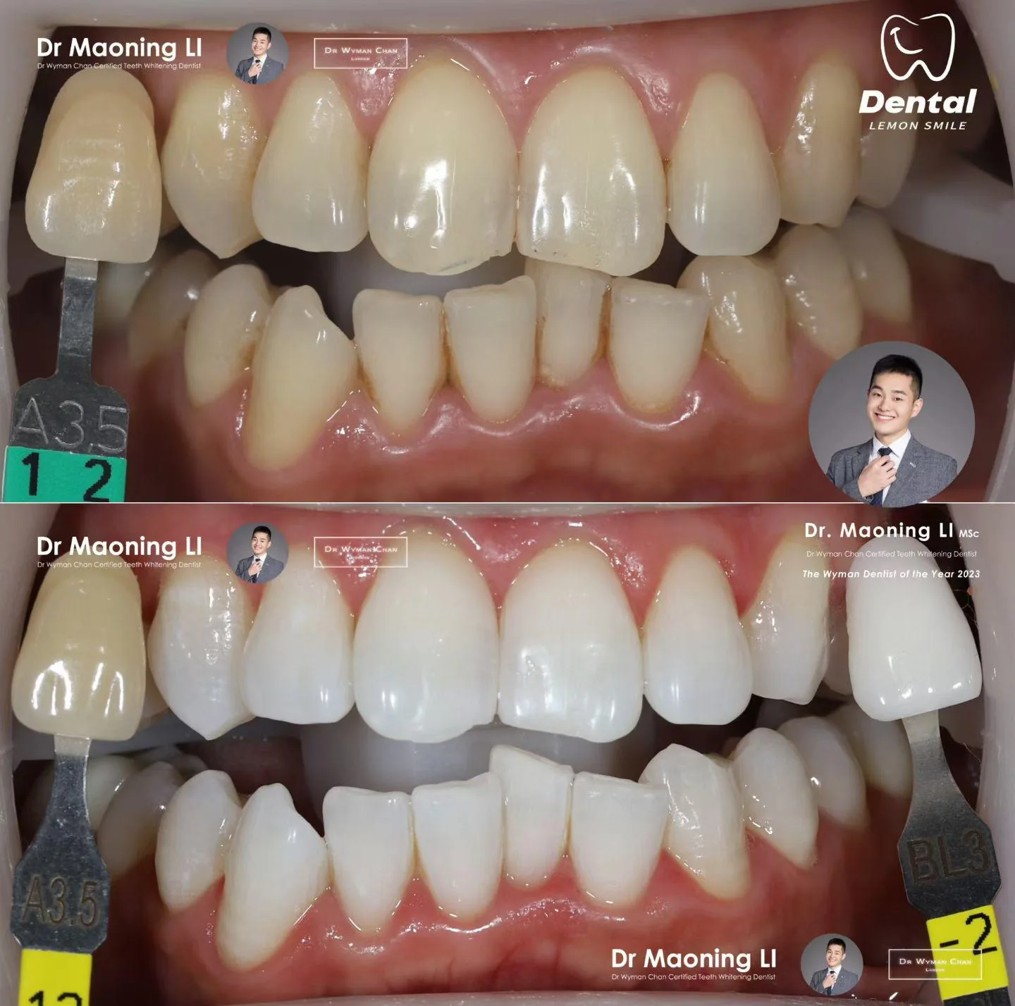 HP6 + Perfect Trays case: baseline before treatment and visibly lighter result after the conscious-bleaching course.
