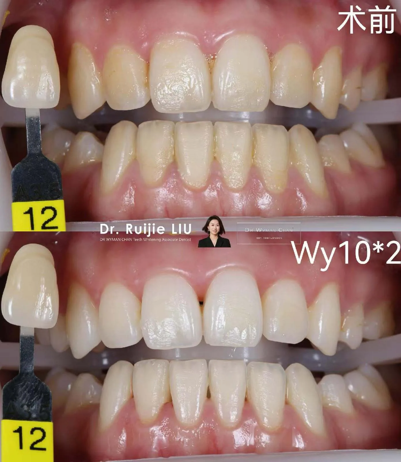 HP6 + Perfect Trays case: before and after a two-week course.