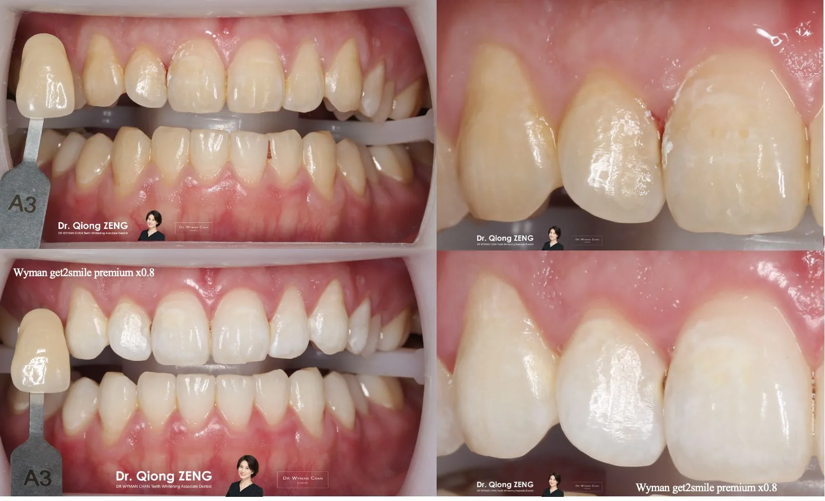 HP6 + Perfect Trays case: before-and-after showing predictable shade change with no marginal sensitivity.